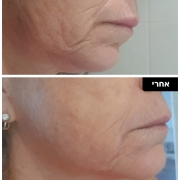 טיפול בפיגמנטציה בפנים