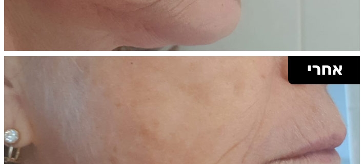 טיפול בפיגמנטציה בפנים