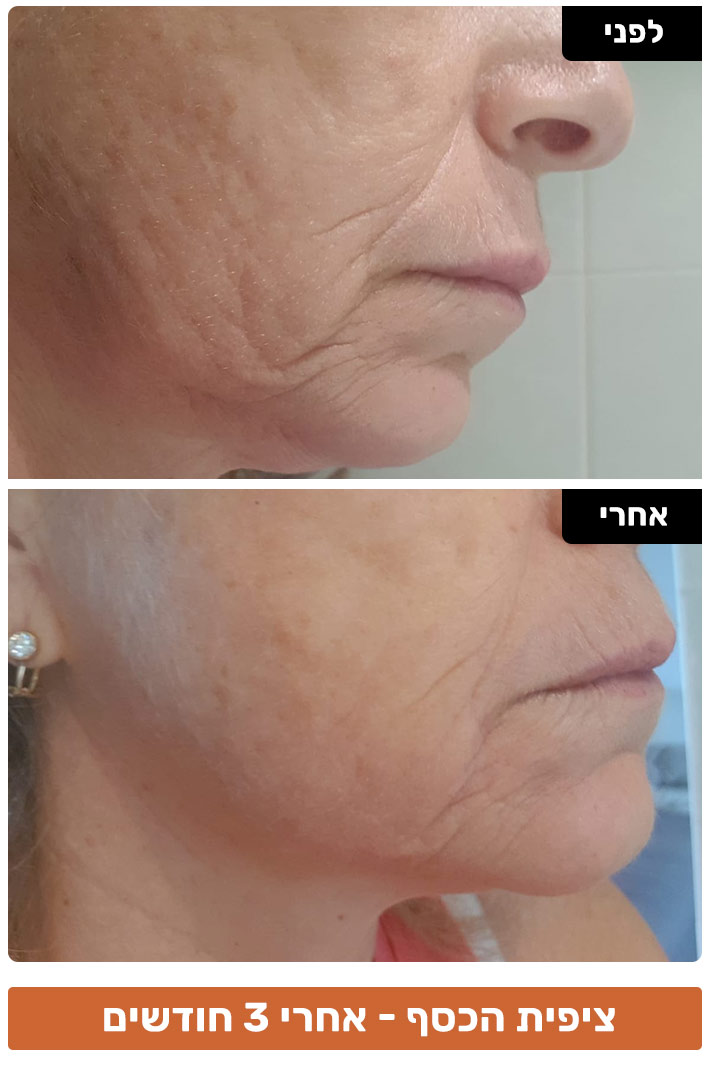 טיפול בפיגמנטציה בפנים