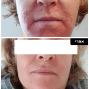 אטופיק דרמטיטיס טיפול