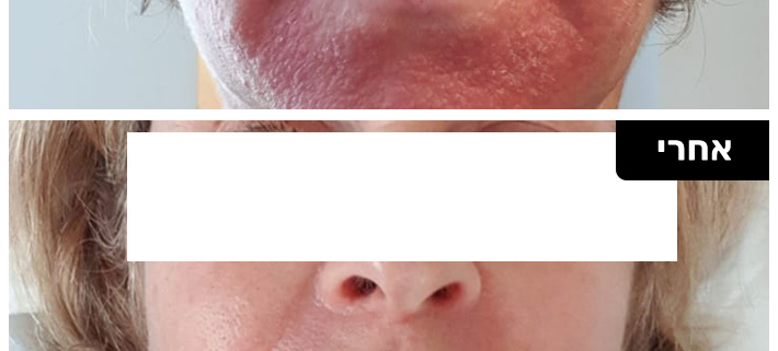 אטופיק דרמטיטיס טיפול