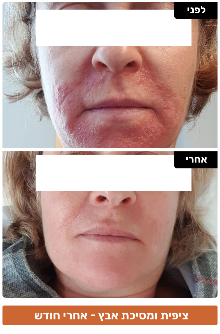 אטופיק דרמטיטיס טיפול